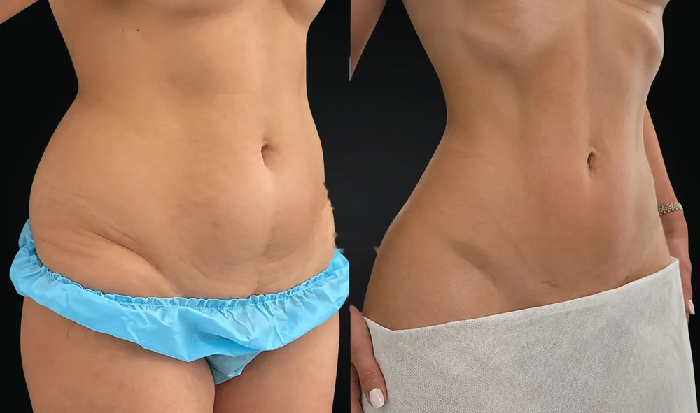 Tummy tuck: a patient's abdomen before and after surgery