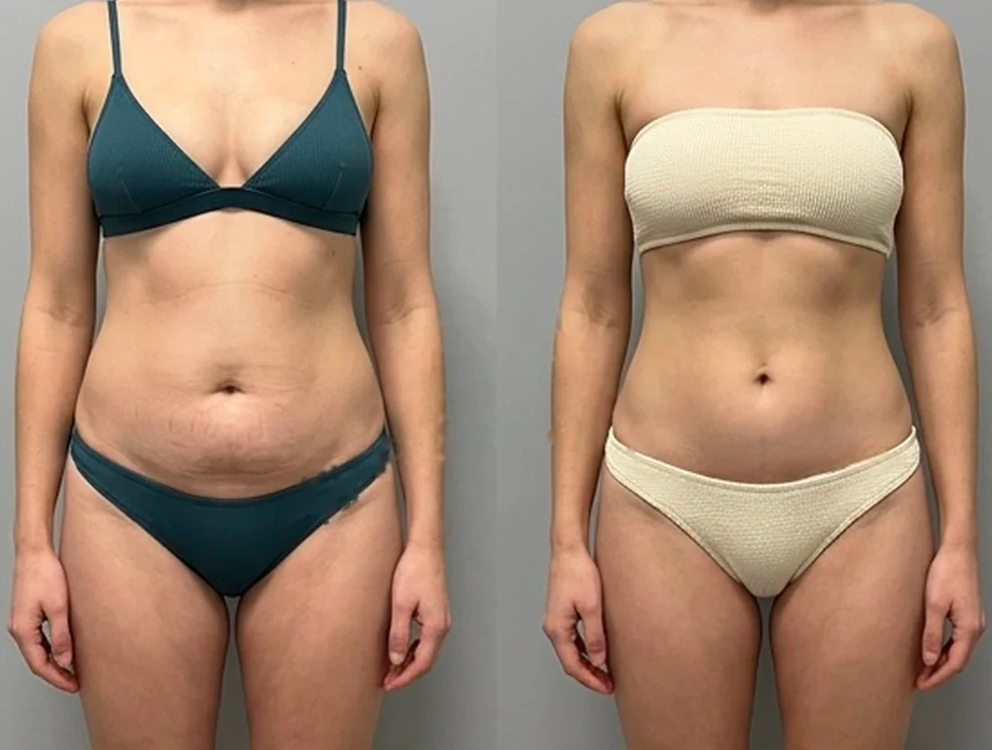 Tummy tuck: a female patient's abdomen before and after surgery