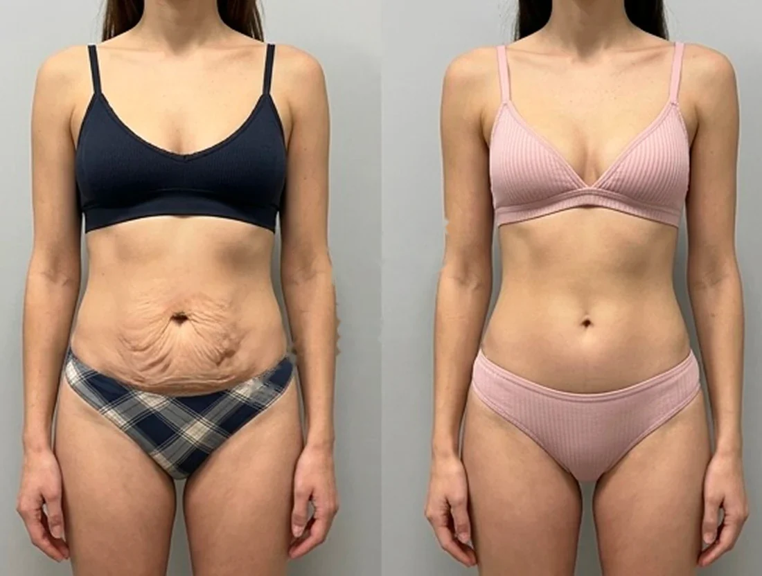 Tummy tuck: a female patient's abdomen before and after surgery