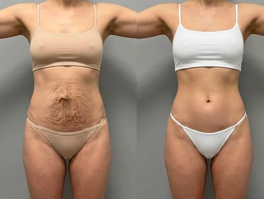 Tummy tuck: a female patient's abdomen before and after surgery
