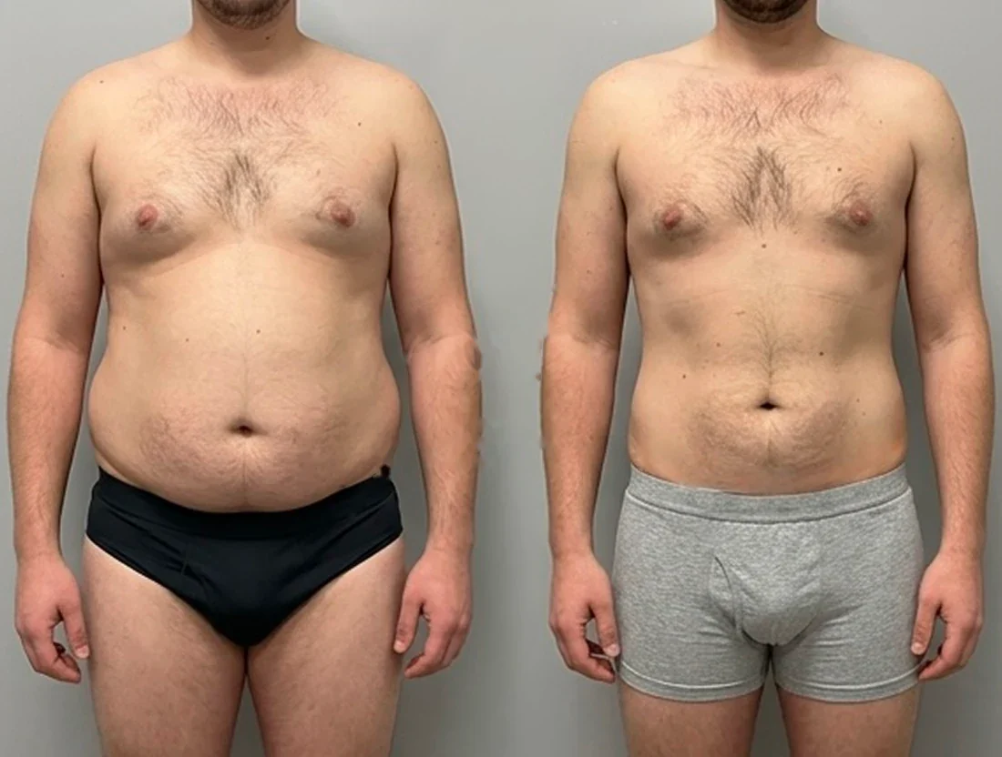 Tummy tuck: a male patient's abdomen before and after surgery