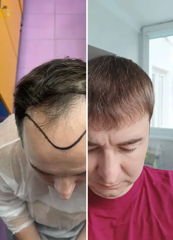 Rezultati naših pacijenata: Prije / Poslije