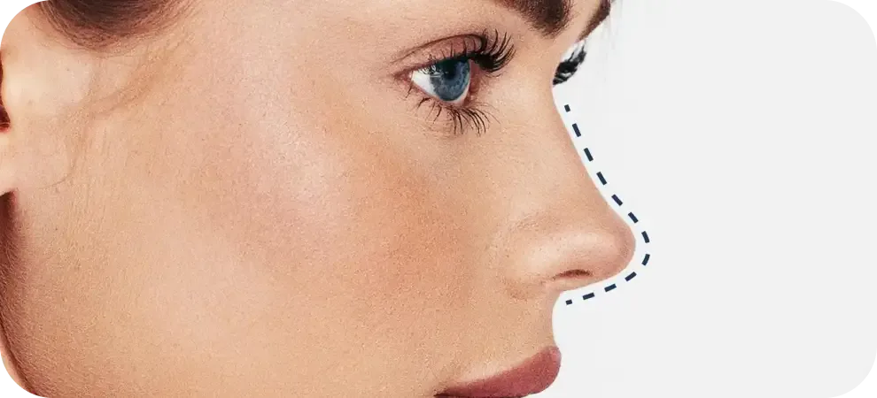 Nose profile before rhinoplasty