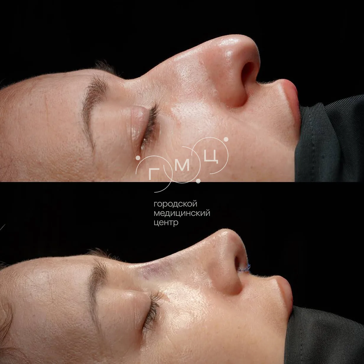 Rhinoplasty: nose shape before surgery and right after it