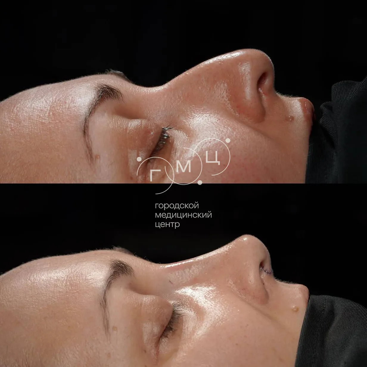 Rhinoplasty: nose shape before surgery and right after it