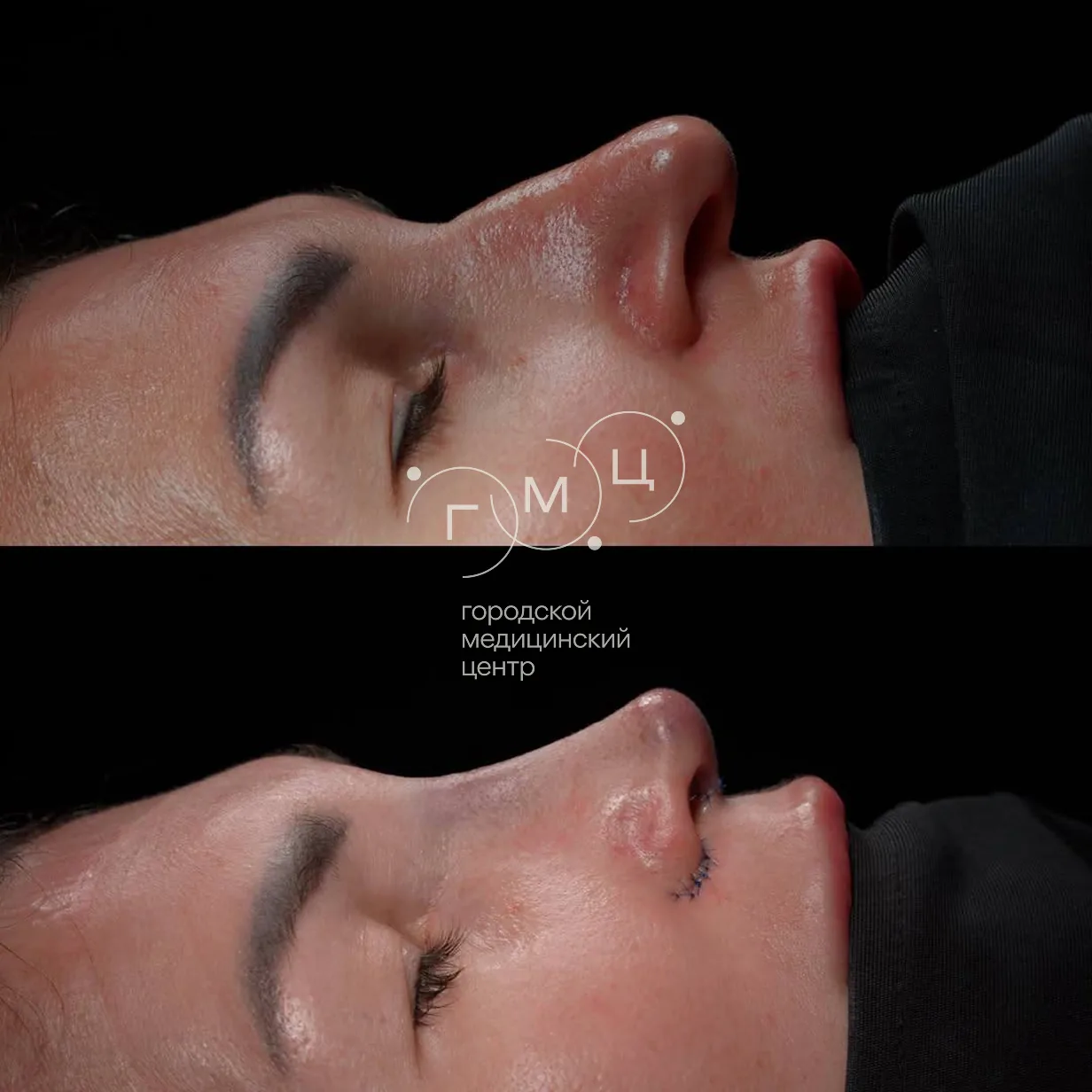 Rhinoplasty: nose shape before surgery and right after it