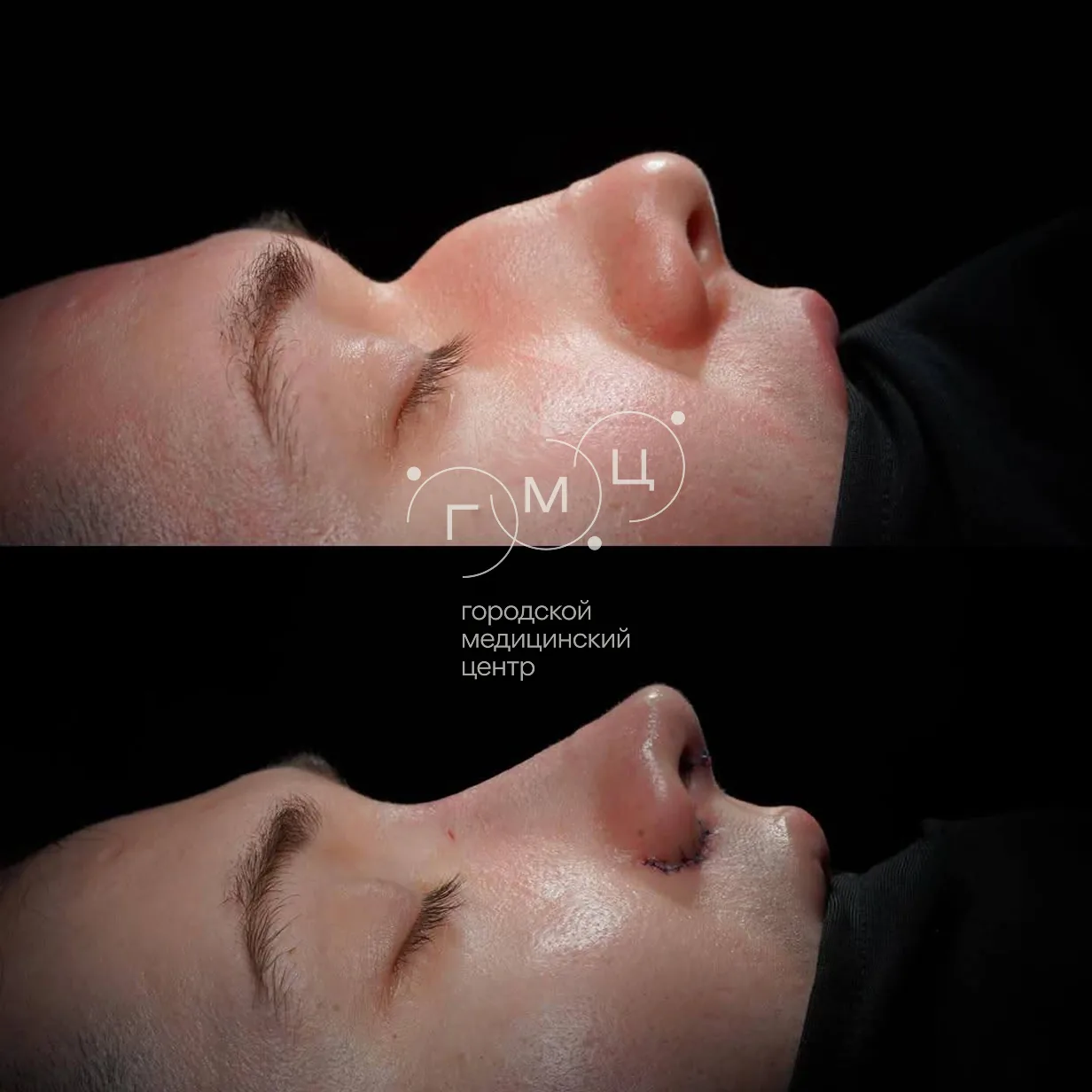 Rhinoplasty: nose shape before surgery and right after it