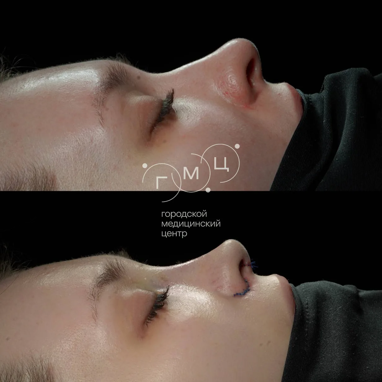 Rhinoplasty: nose shape before surgery and right after it
