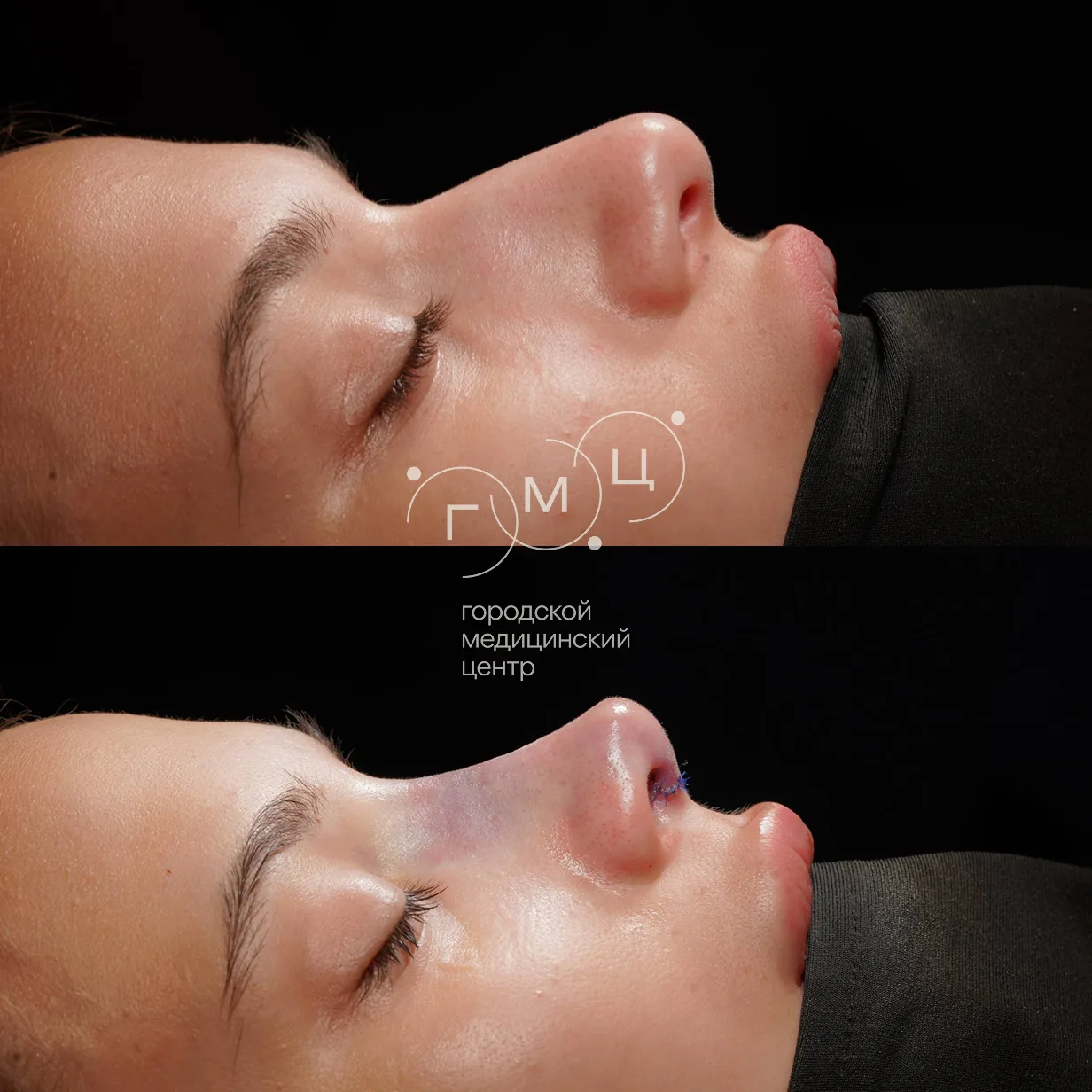 Rhinoplasty: nose shape before surgery and right after it