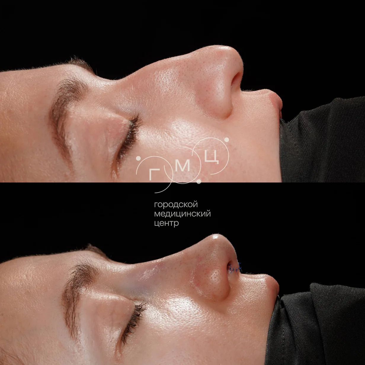 Rhinoplasty: nose shape before surgery and right after it