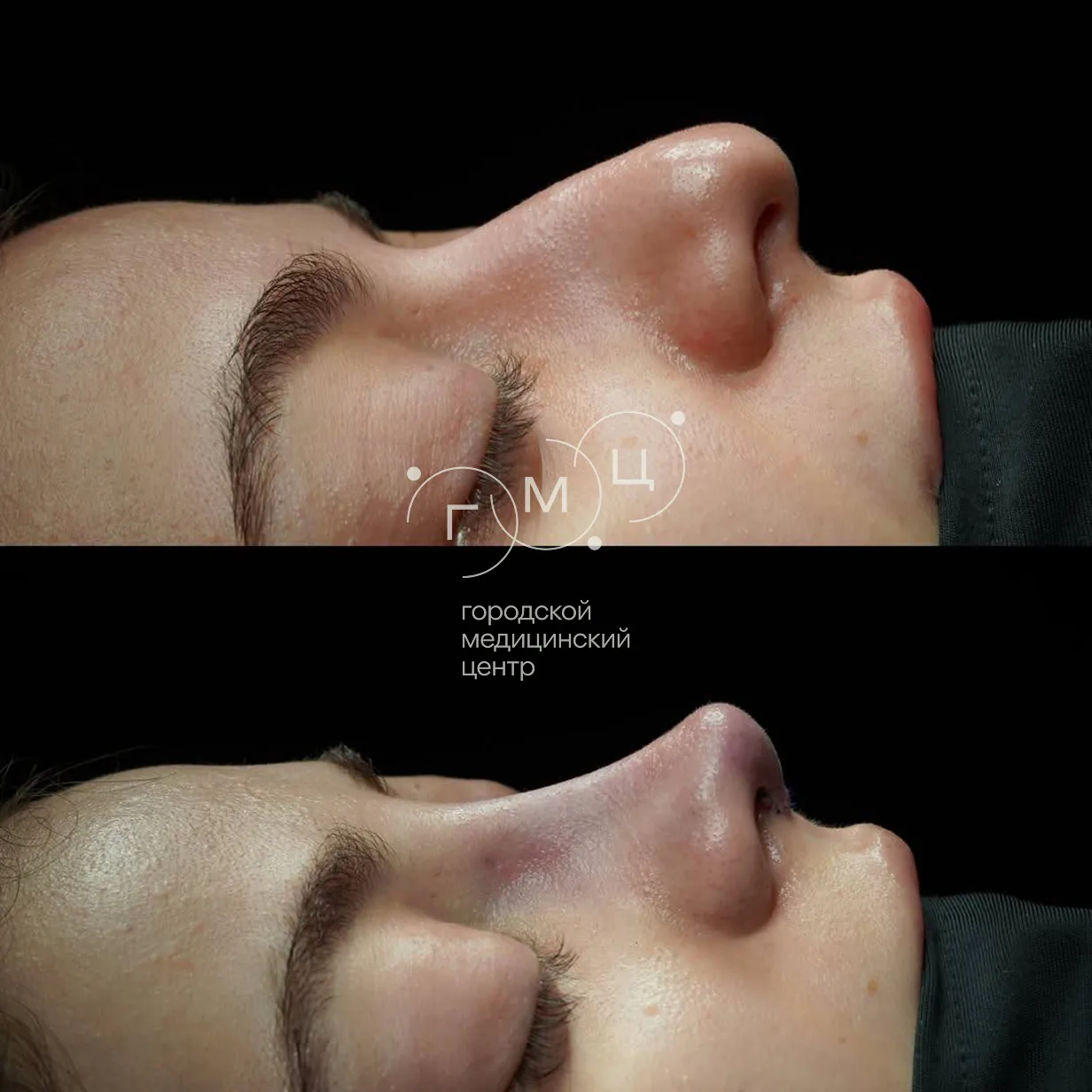 Rhinoplasty: nose shape before surgery and right after it