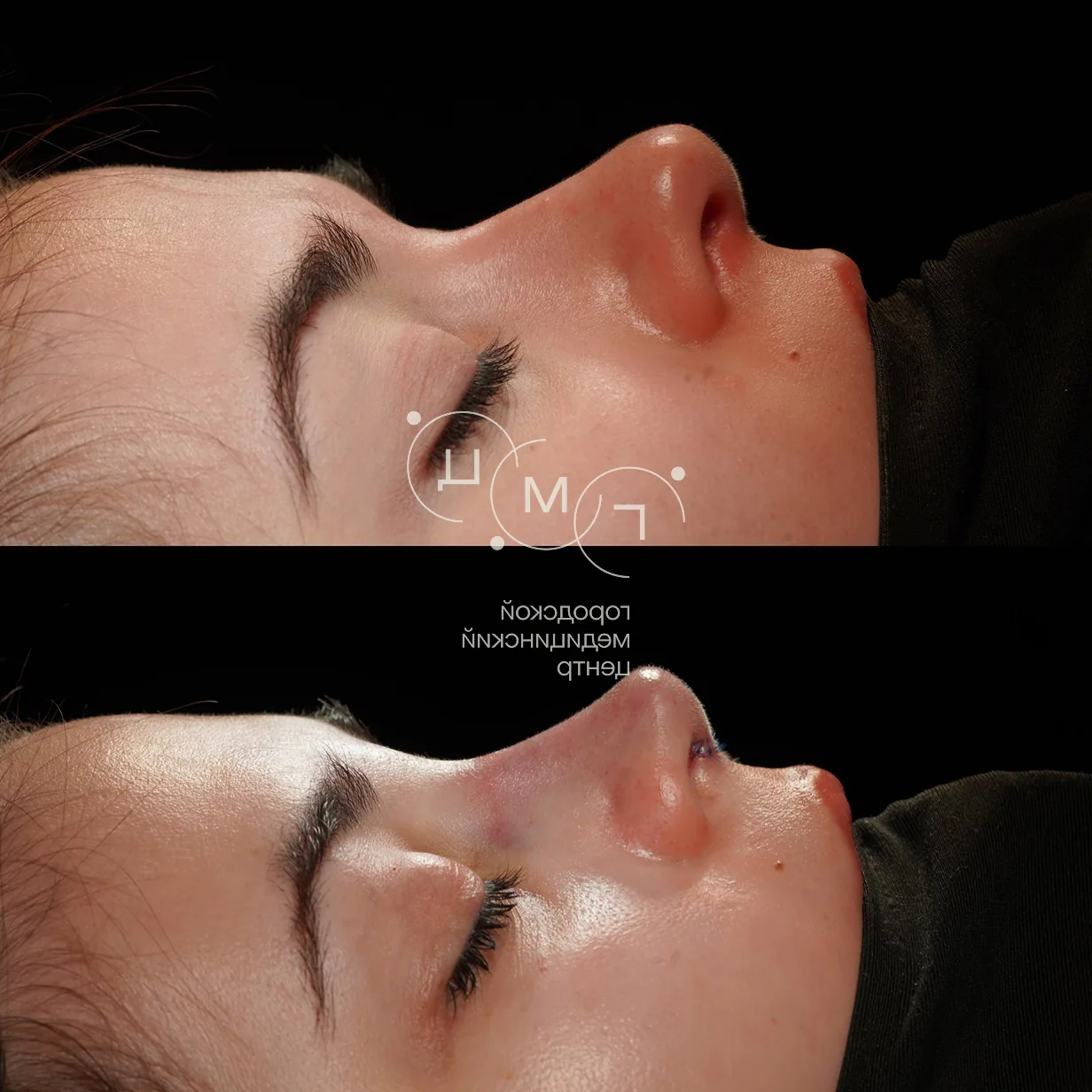 Rhinoplasty: nose shape before surgery and right after it