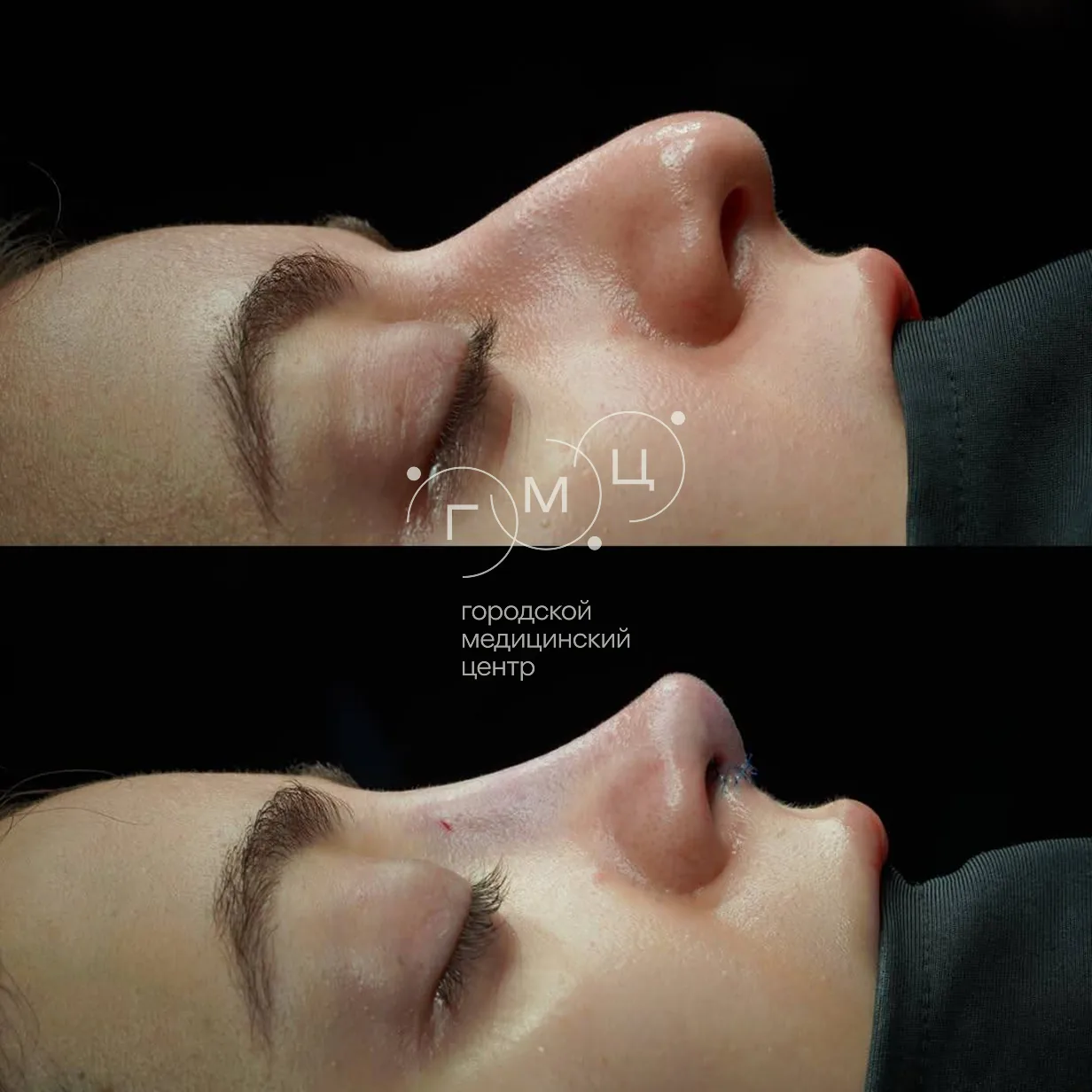 Rhinoplasty: nose shape before surgery and right after it