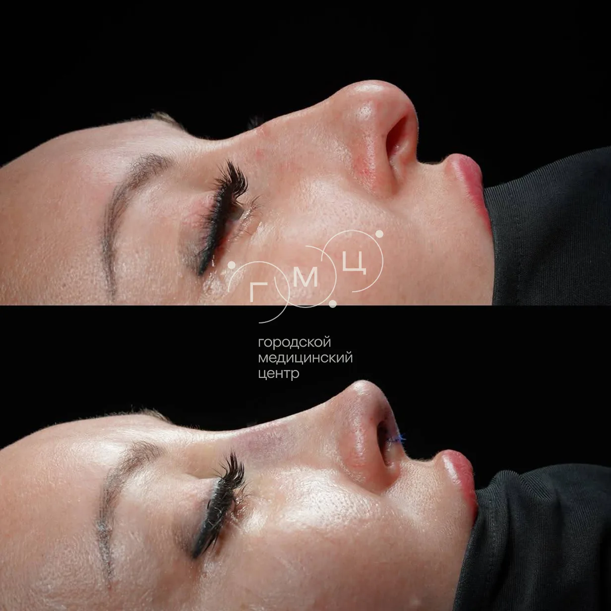 Rhinoplasty: nose shape before surgery and right after it
