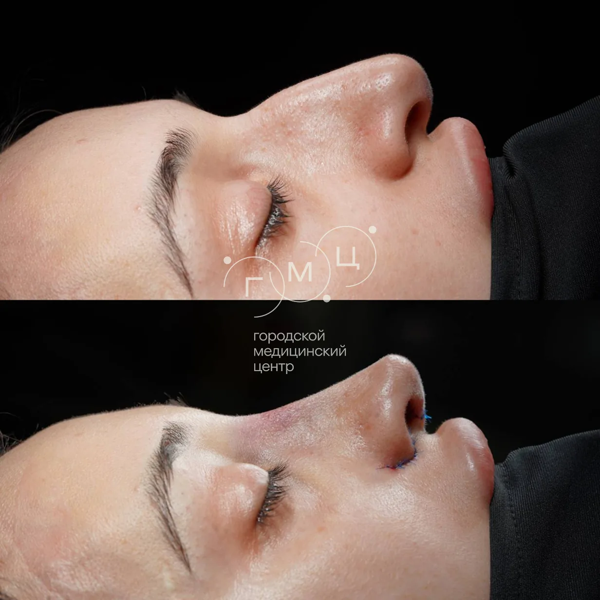 Rhinoplasty: nose shape before surgery and right after it