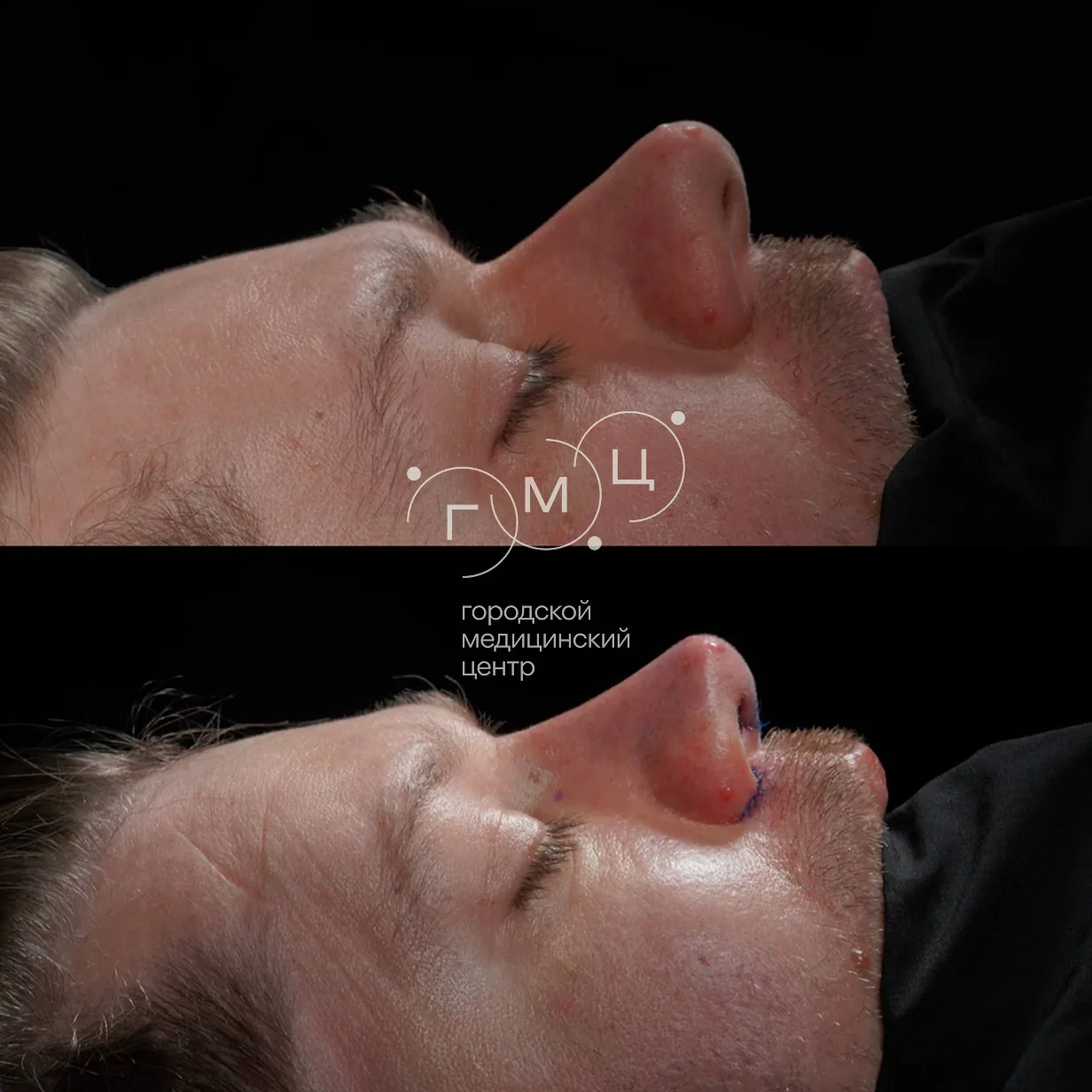 Rhinoplasty: nose shape before surgery and right after it
