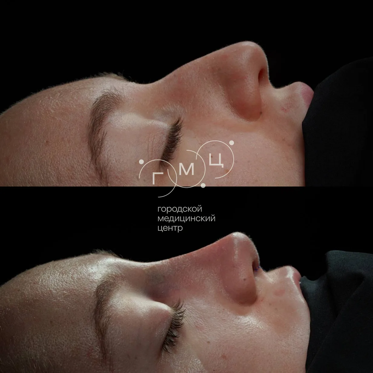 Rhinoplasty: nose shape before surgery and right after it