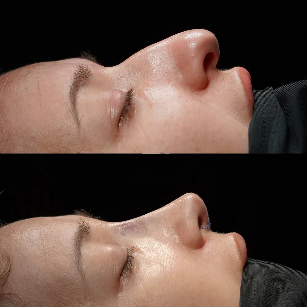 Rhinoplasty: nose shape before and after surgery