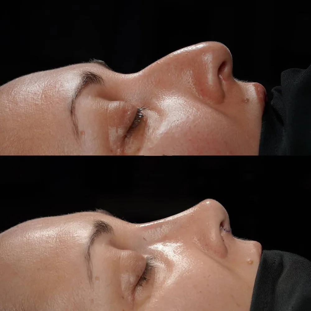 Rhinoplasty: nose shape before and after surgery