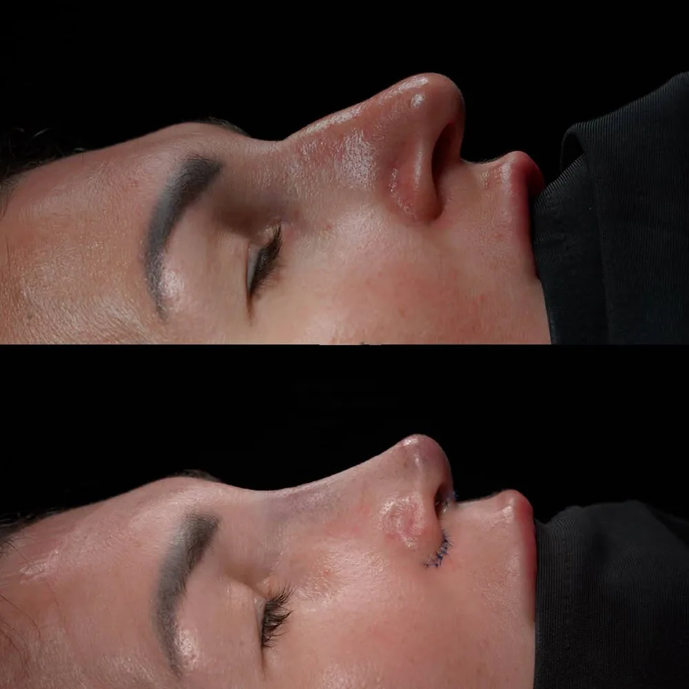 Rhinoplasty: nose shape before and after surgery