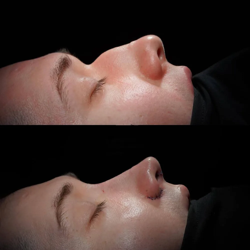 Rhinoplasty: nose shape before and after surgery