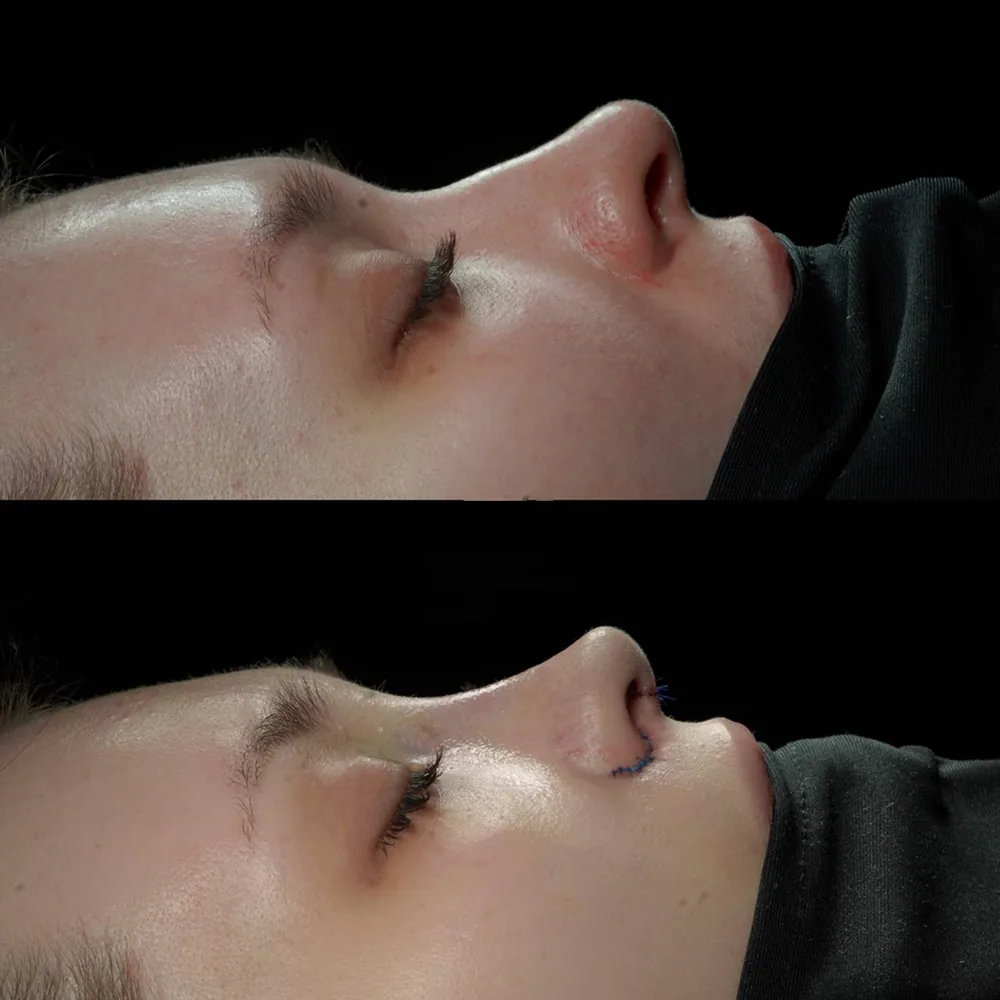 Rhinoplasty: nose shape before and after surgery