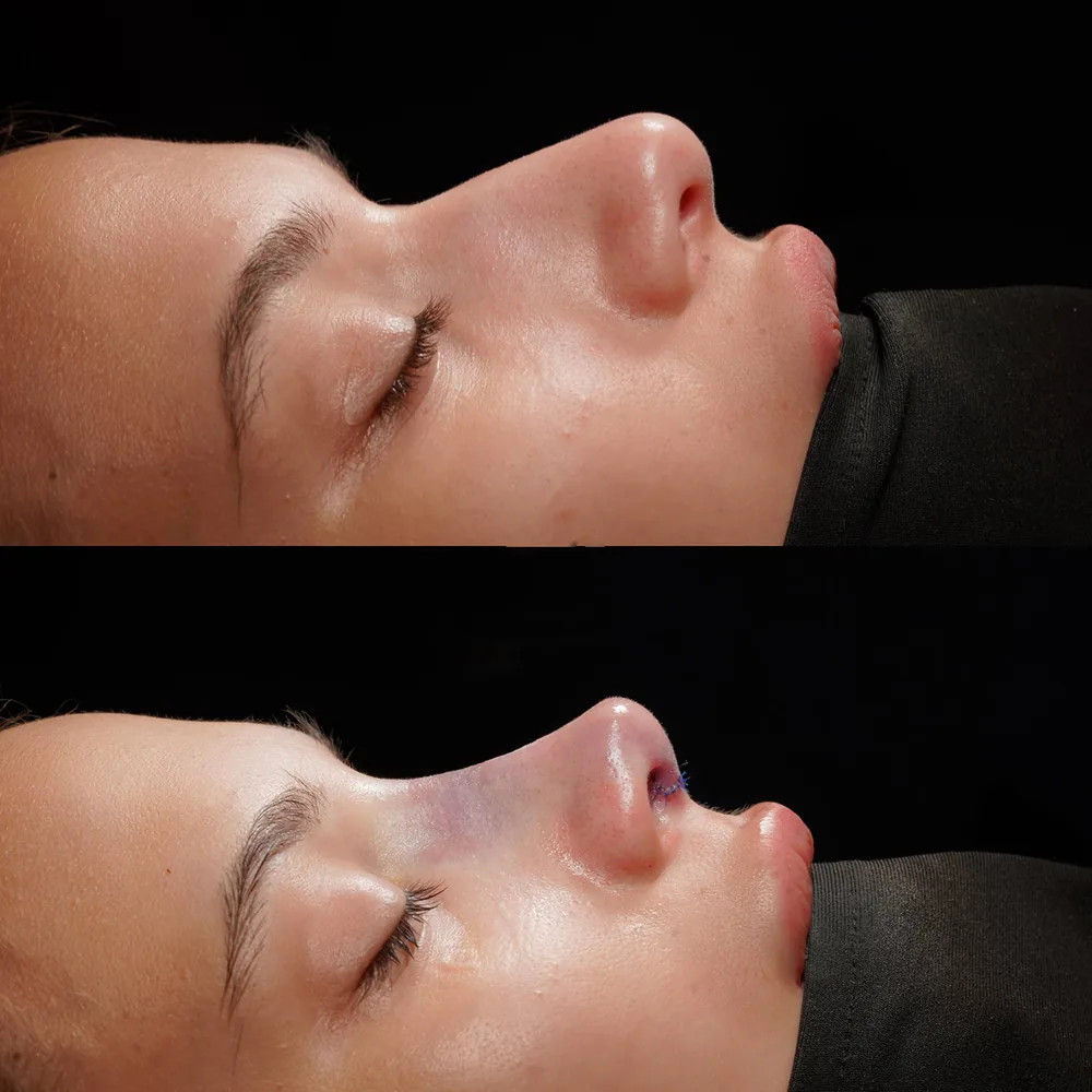 Rhinoplasty: nose shape before and after surgery