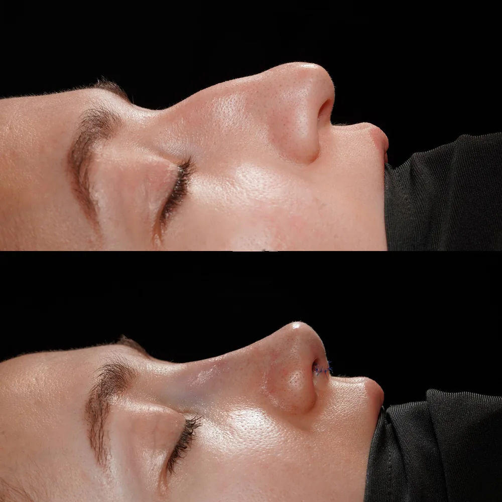 Rhinoplasty: nose shape before and after surgery