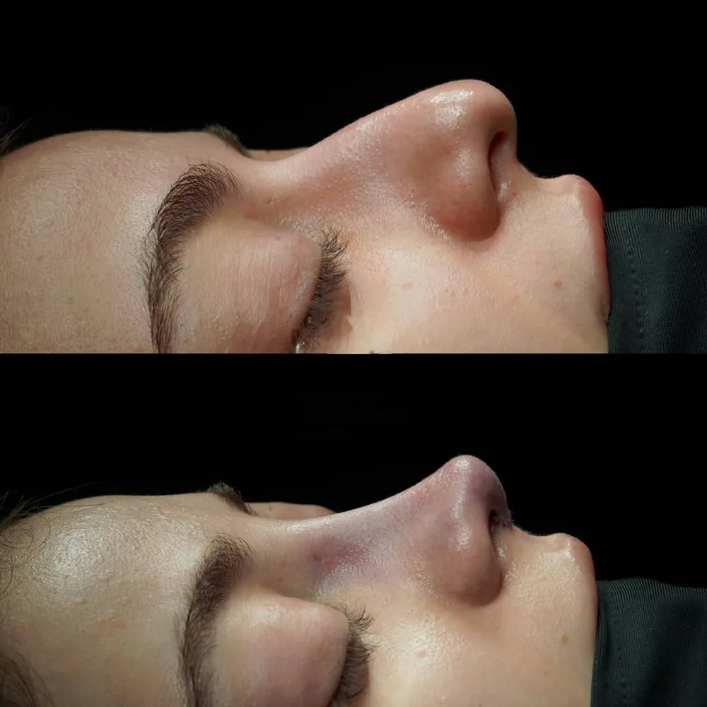 Rhinoplasty: nose shape before and after surgery