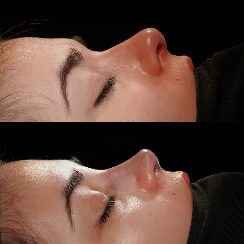 Rhinoplasty: nose shape before and after surgery