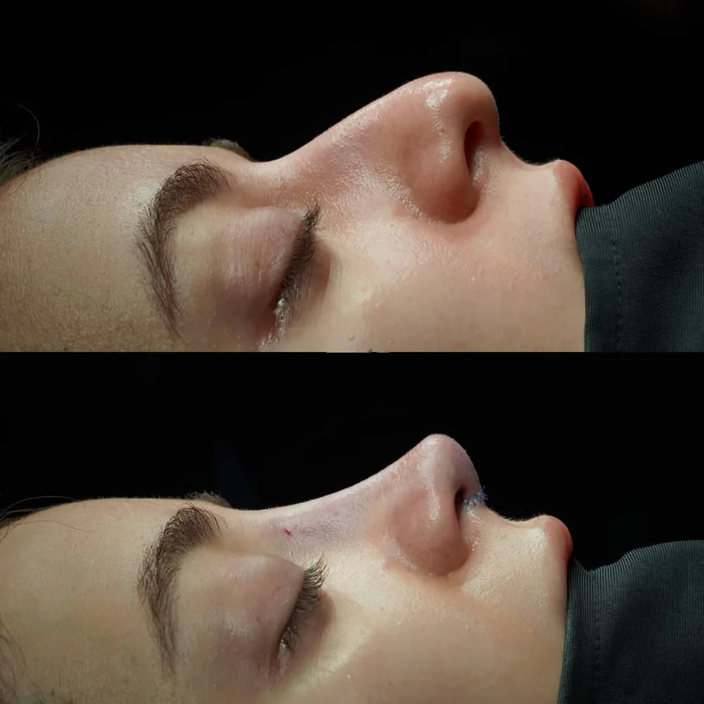 Rhinoplasty: nose shape before and after surgery