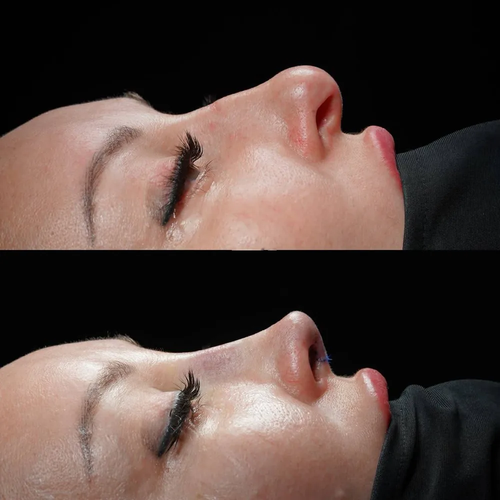 Rhinoplasty: nose shape before and after surgery