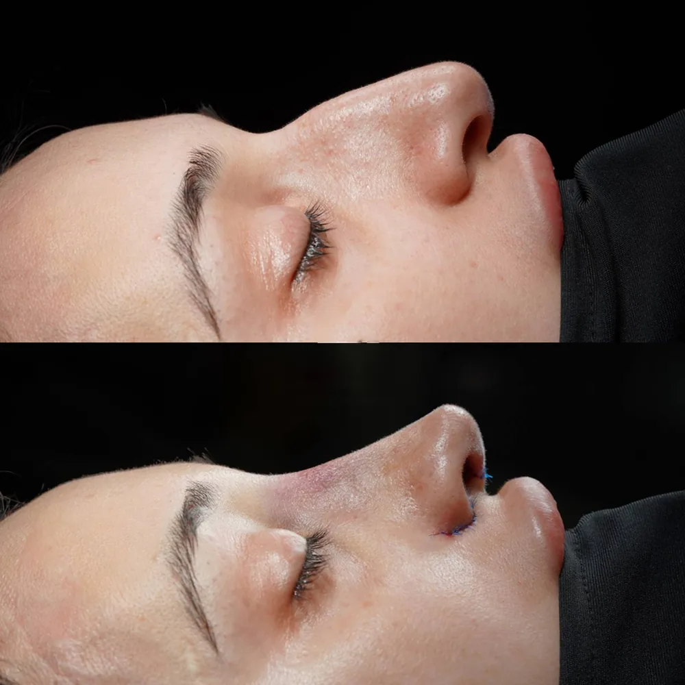 Rhinoplasty: nose shape before and after surgery