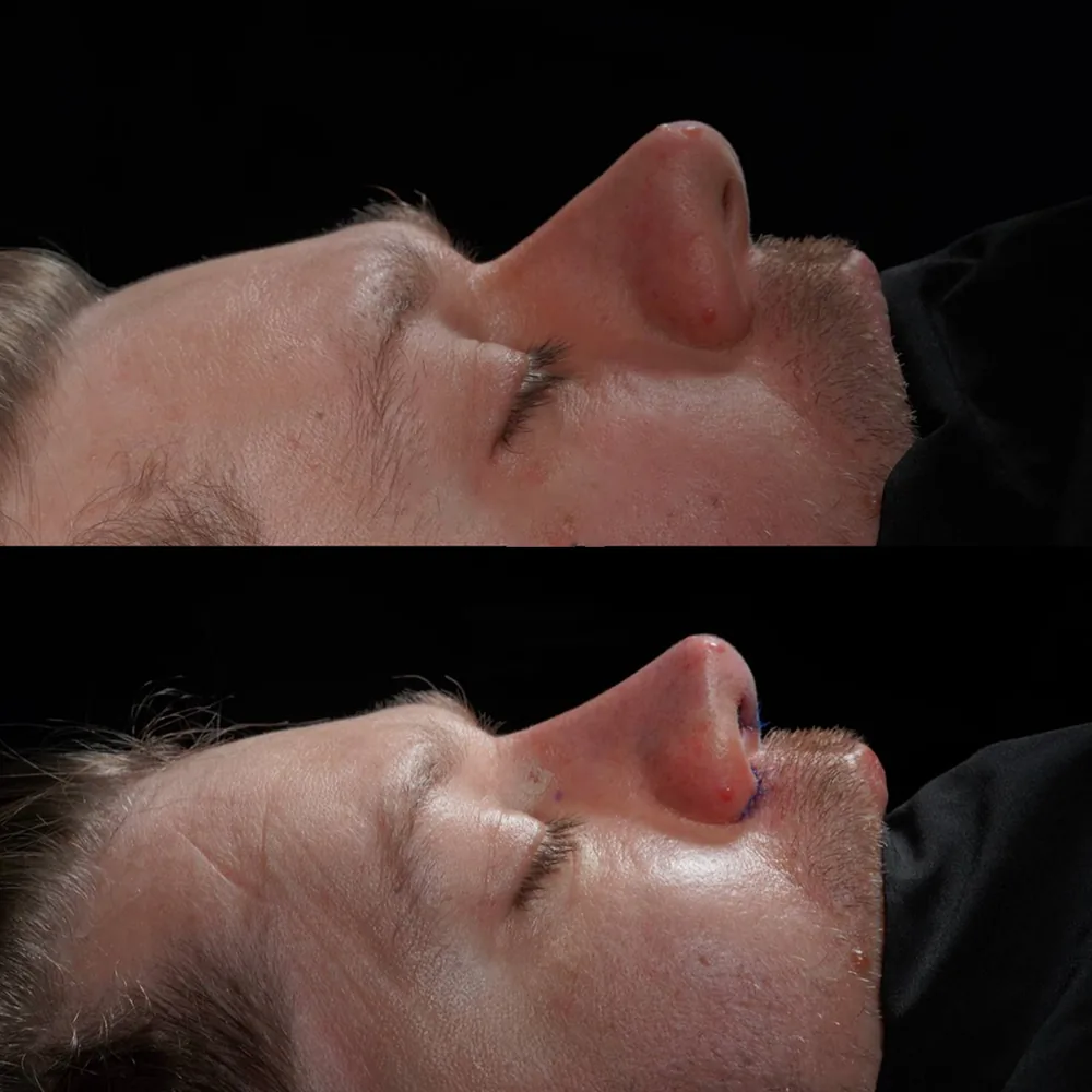 Rhinoplasty: nose shape before and after surgery