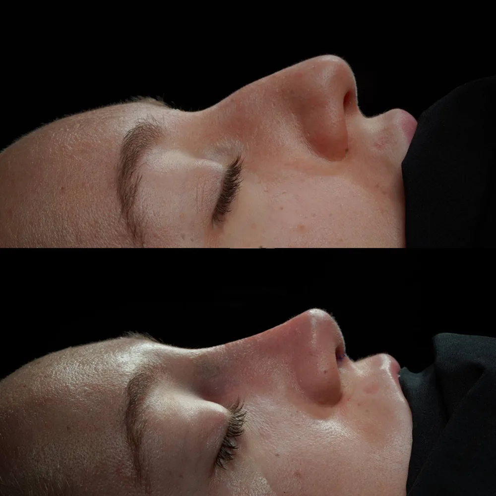 Rhinoplasty: nose shape before and after surgery