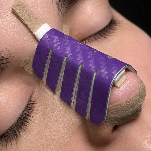 A patient after rhinoplasty: purple carbon-look splint
