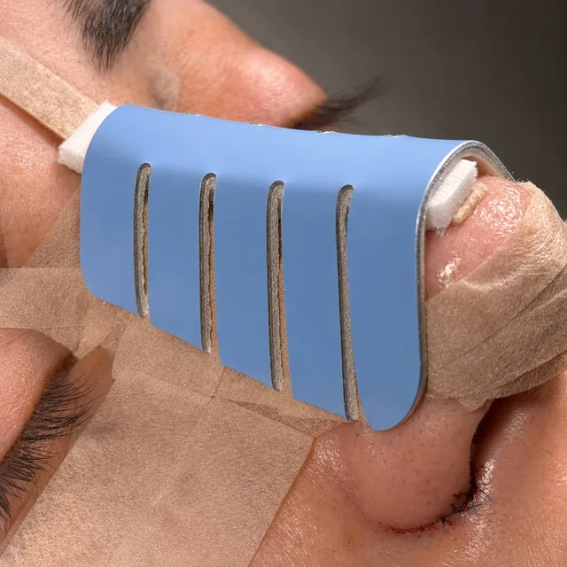 A patient after rhinoplasty: light blue splint