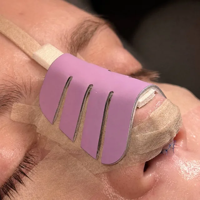 A patient after rhinoplasty: pink splint