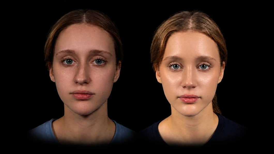 Patient before and after primary rhinoplasty, front view