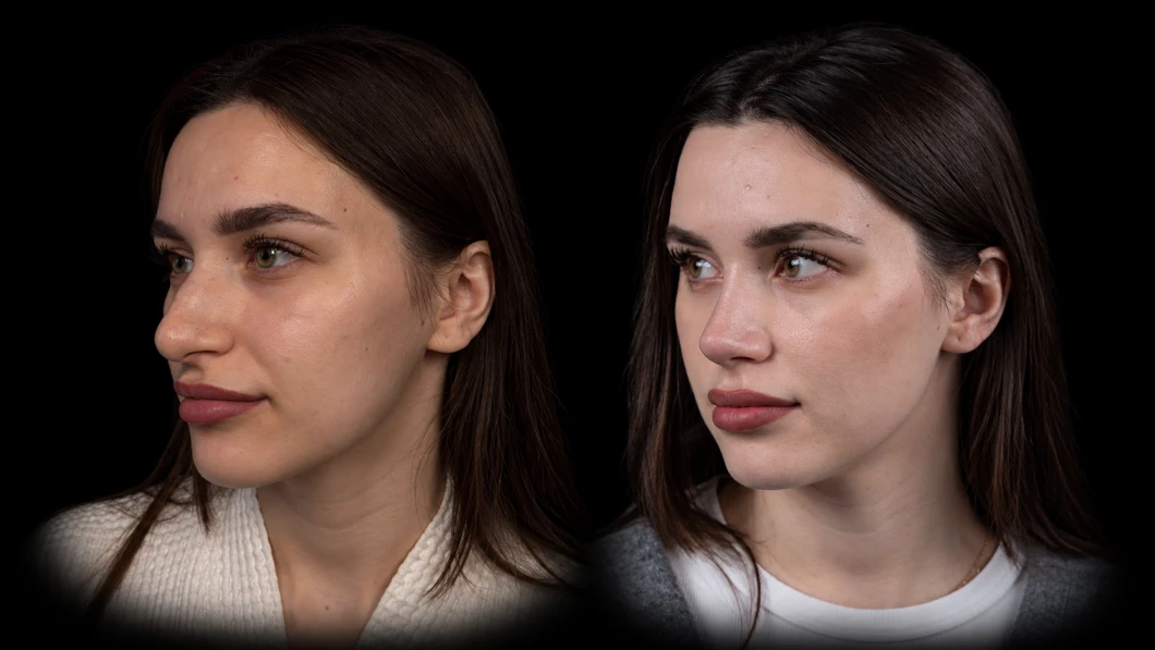 Patient before and after revision rhinoplasty, three-quarter view