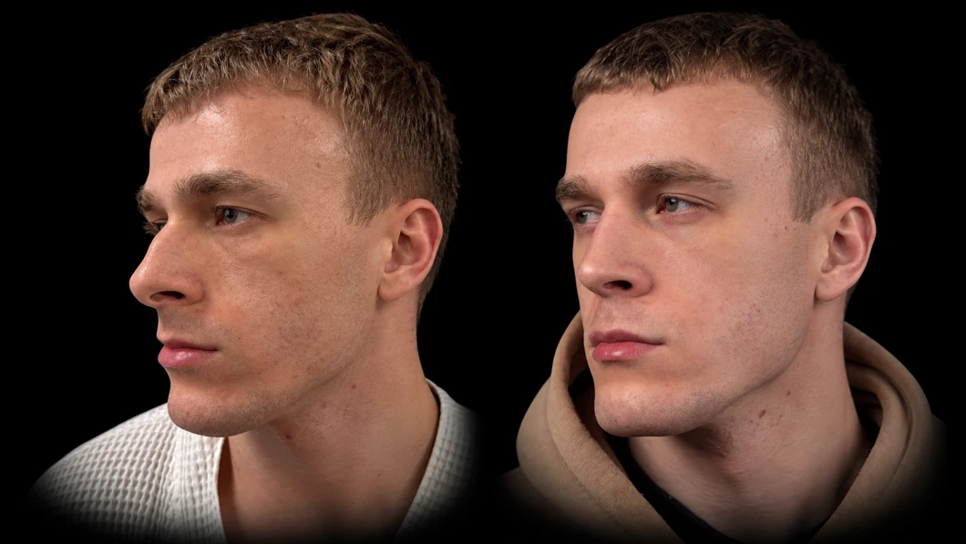 Patient before and after rhinoseptoplasty