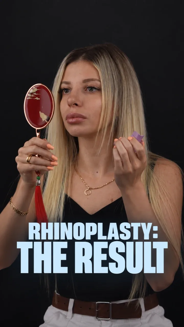 Patient looking at her nose right after the splint is removed
