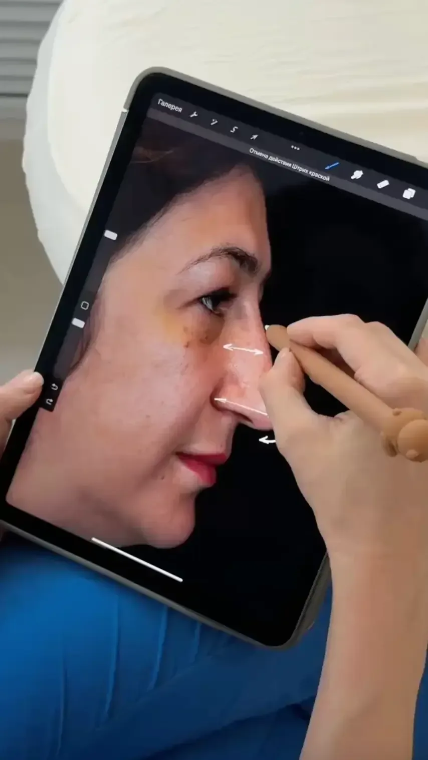 Operating team during rhinoplasty