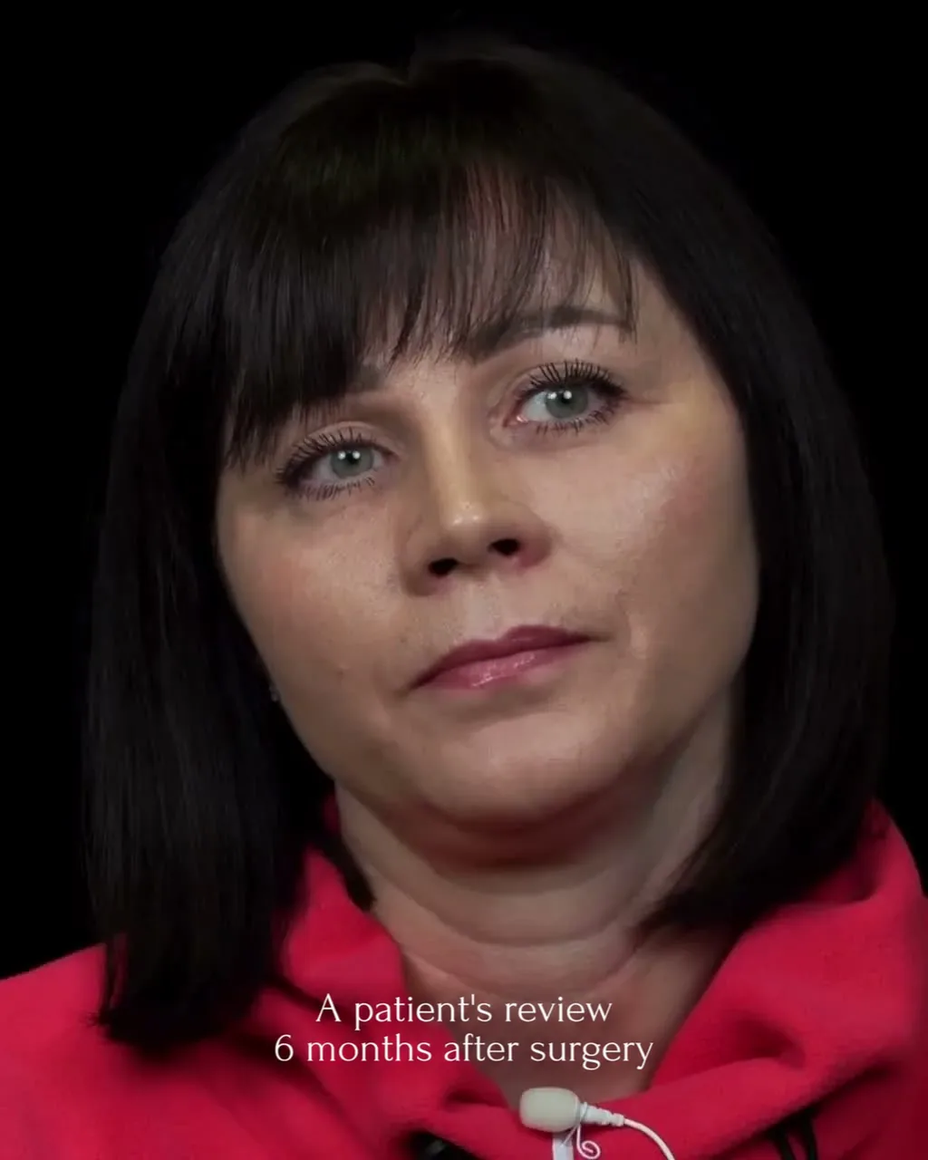 Patient talks about rhinoplasty 6 months after surgery
