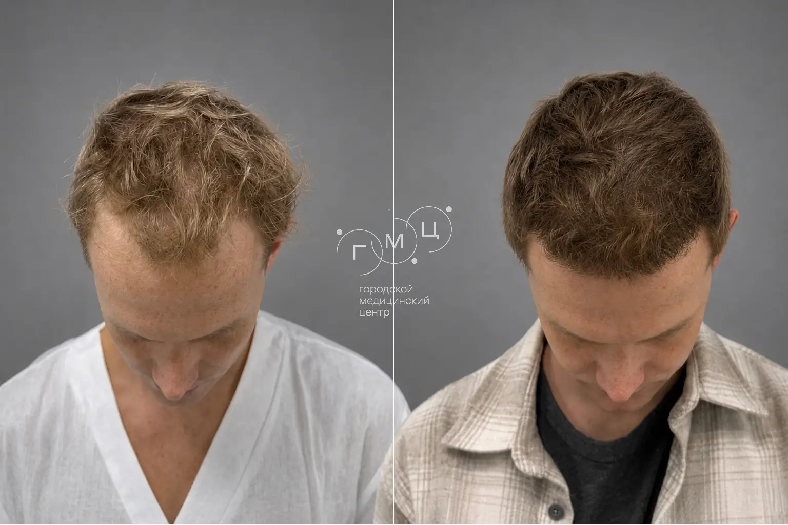 Scalp hair transplant: photo before and 12 months later, 3400 grafts, FUE method