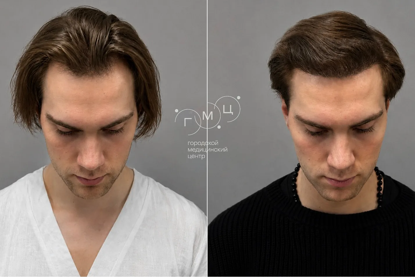 Scalp hair transplant: photo before and 12 months later, 2500 grafts, FUE method
