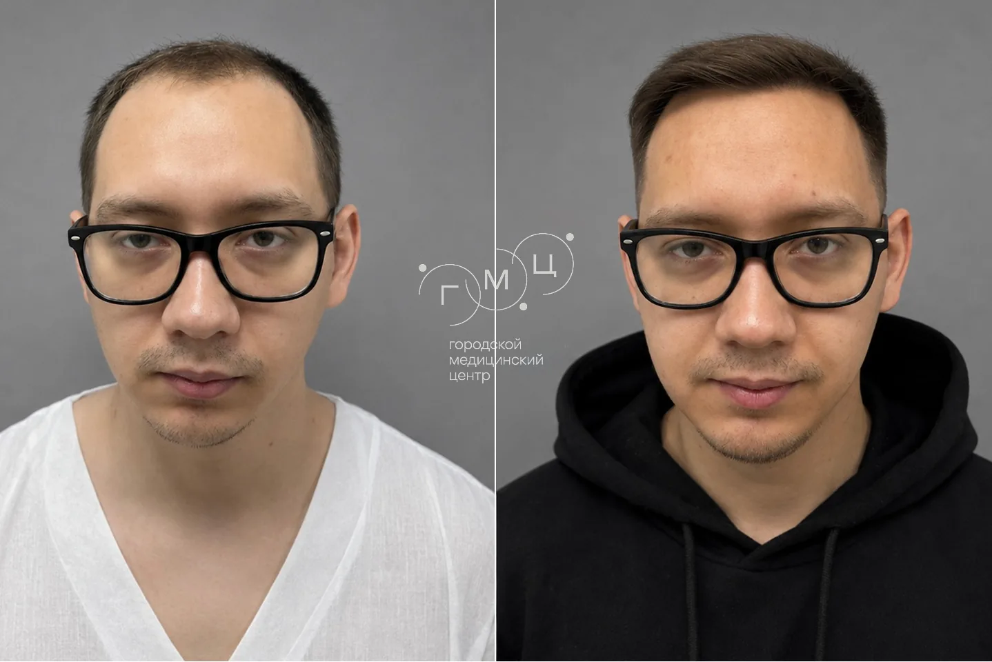 Scalp hair transplant: photo before and 12 months later, 3100 grafts, FUE method
