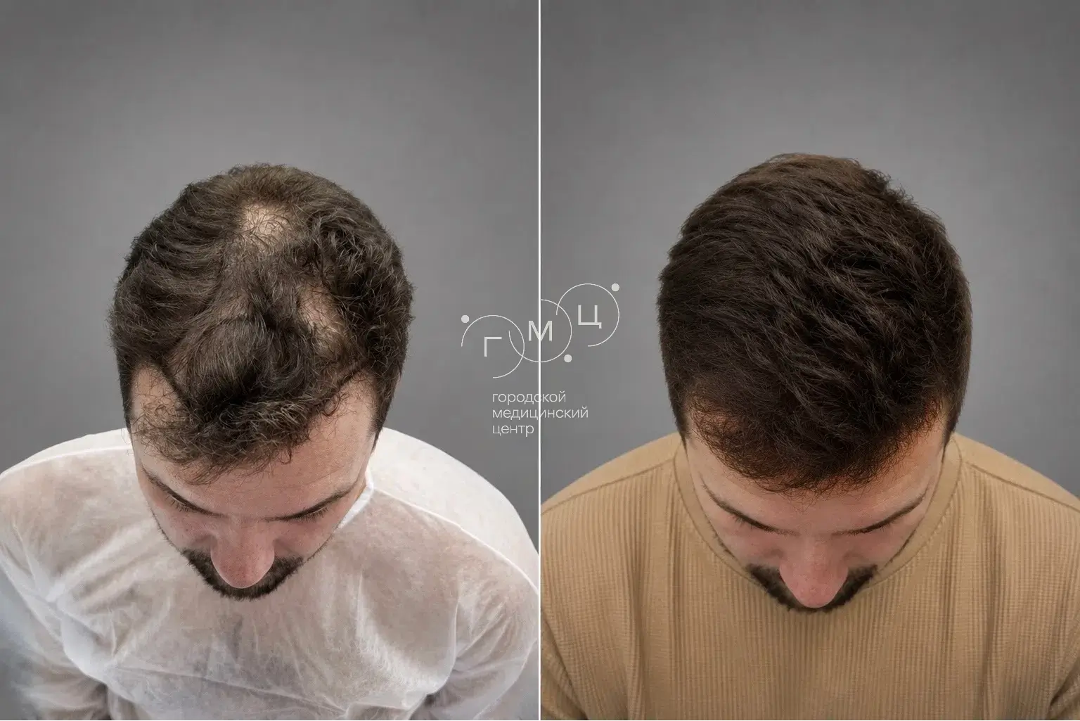 Scalp hair transplant: photo before and 12 months later, 3600 grafts, FUE method