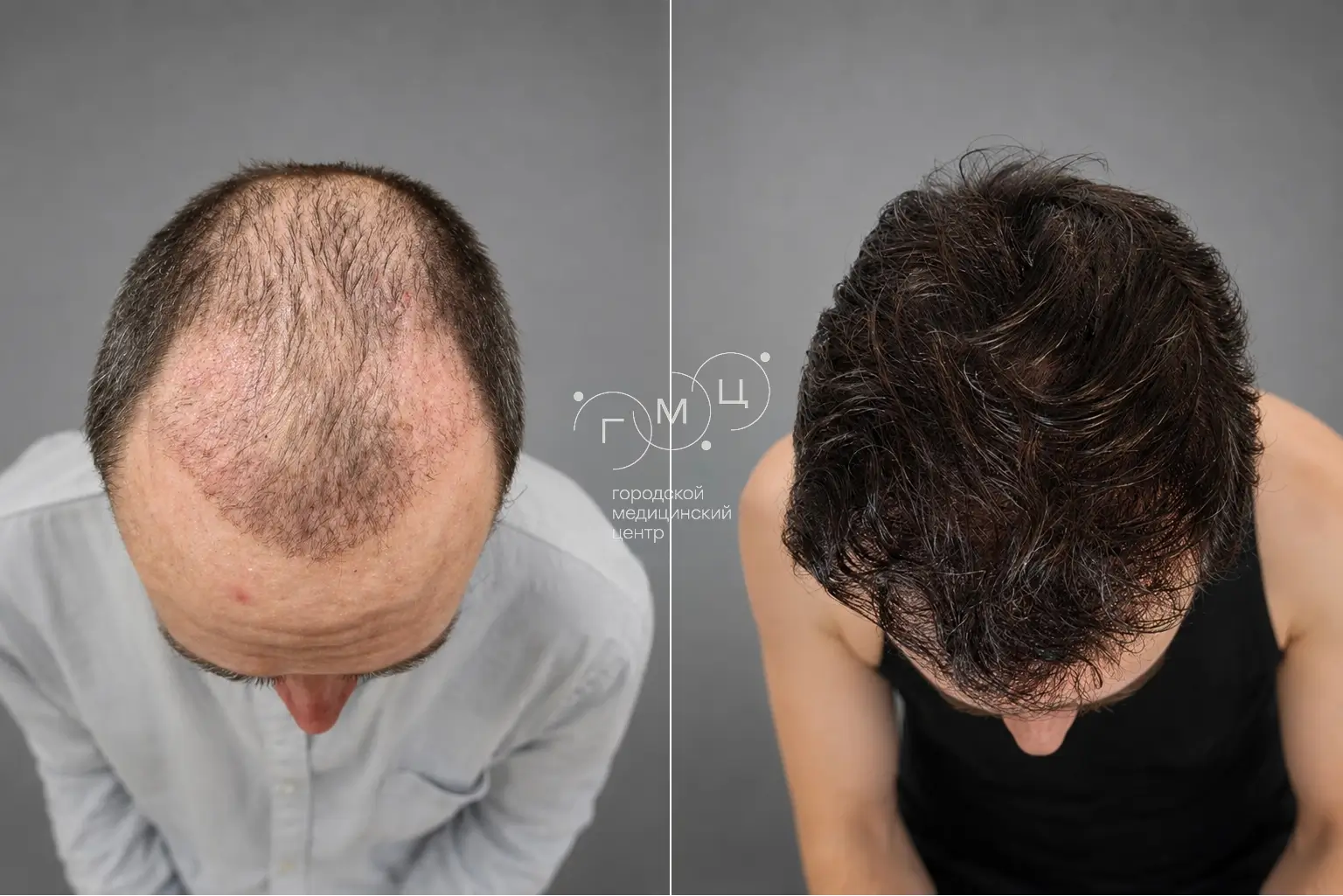 Scalp hair transplant: photo before and 12 months later, 4000 grafts, FUE method