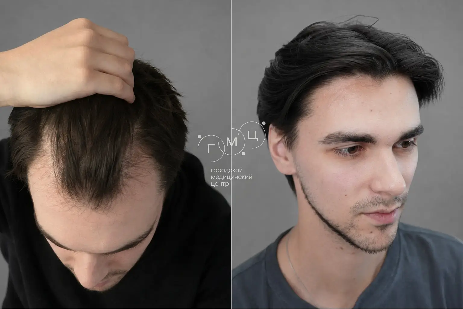 Scalp hair transplant: photo before and 12 months later, 3200 grafts, FUE method